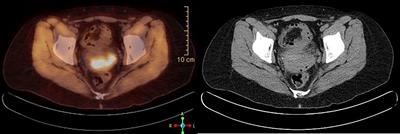 Case Report: Immune Checkpoint Inhibitors as a Single Agent in the Treatment of Metastatic Cervical Cancer